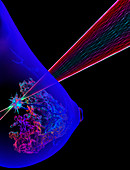 Breast cancer radiotherapy,3D MRI-based illustration