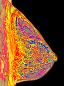 Fibrocystic breast disease,MRI scan