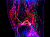 Knee joint,3D MRI scan