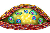 Structure of atherosclerotic plaque,illustration