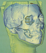 Stages in facial reconstruction of the bathrocranic skull