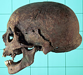 Stages in facial reconstruction of the bathrocranic skull