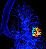 Lung cancer, 3D CT scan