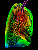 Pulmonary tuberculosis, 3D CT scan