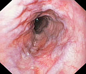 Oesophageal varices, endoscopic image