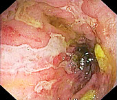 Large intestine in Crohn's disease, endoscopic image