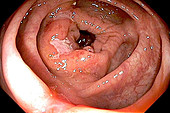 Large intestine in Crohn's disease, endoscopic image