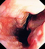 Oesophageal varices in Banti's syndrome, endoscopic image
