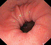 Normal pyloric sphincter, endoscopic image