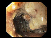 Gastric retention in diabetes, colonoscopy image