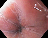 Achalasia of the oesophagus, endoscopy image