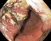 Stomach cancer, colonoscopy image