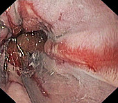 Oesophagitis, endoscopic image
