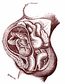 Calcified foetus, 19th century