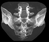 Sacrum following laminectomy, CT scan