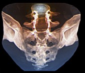 Sacrum following laminectomy, CT scan