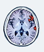 Brain activity in speech production, MRI