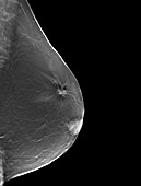 Breast lump, CT scan