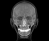 Normal human skull, 3D CT scan