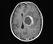 Brain cancer, MRI