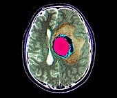 Brain cancer, MRI