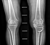 Osteoarthritis of the knee, X-ray