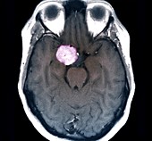 Meningioma brain tumour, MRI scan