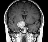 Meningioma brain tumour, MRI scan