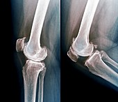 Osteoarthritis of the knee, X-rays