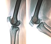 Osteoarthritis of the knee, X-rays