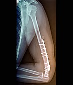 Fixed upper arm fracture, X-ray