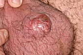 Infected sebaceous cyst on scrotum