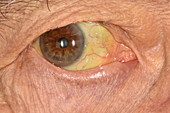 Drug-induced jaundiced eye