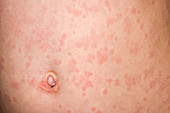 Urticaria rash due to vaccine reaction