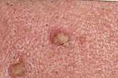 Solar keratosis growths