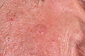 Bowenoid keratosis