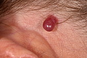 Capillary haemangioma