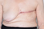 Breast cancer removal scars