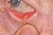 Chalazion cyst on an eyelid