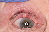 Chalazion cyst on an eyelid