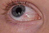 Episcleritis