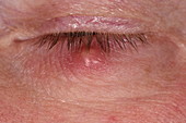 Chalazion cyst on an eyelid