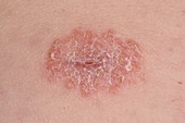 Psoriasis associated with a surgical wound