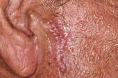 Scar after basal cell carcinoma excision