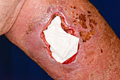 Leg wound treatment following a fall