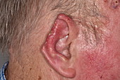 Deformed ear after basal cell carcinoma excision
