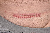 Pelvic fracture surgery scar