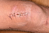 Treated leg wound following a fall