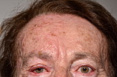 Shingles rash affecting facial nerve