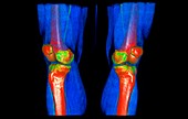 Knee joints and muscles, 3D CT scan